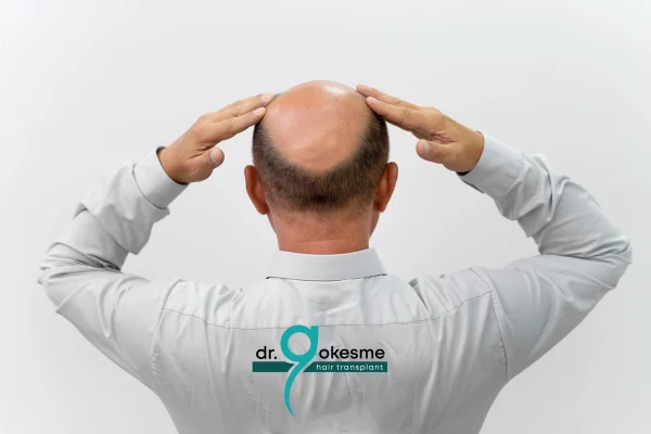 How Much Does Hair Transplant Cost in 6 Months