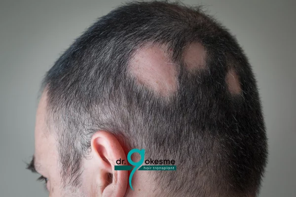 What is Ringworm and How is It Treated